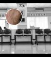 他克莫司要用多久见效