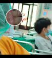 白癜风看不见白斑了还用照308光疗吗为什么